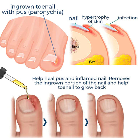 German ToenailPlus™ Anti Paronychia Relief Oil Nail Fungus