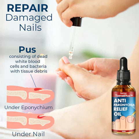 German ToenailPlus™ Anti Paronychia Relief Oil Nail Fungus